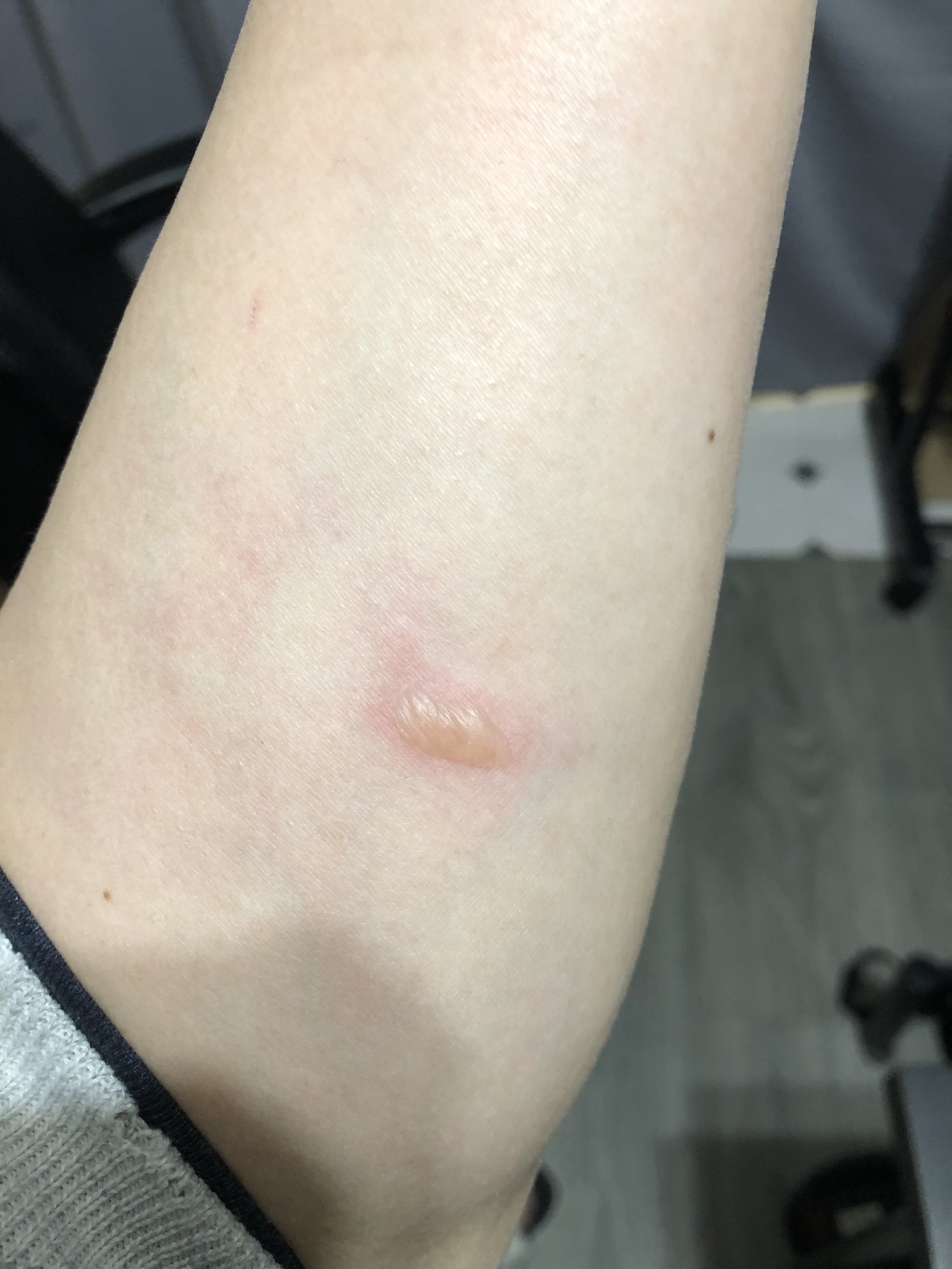 Am i getting allergy or mite bites