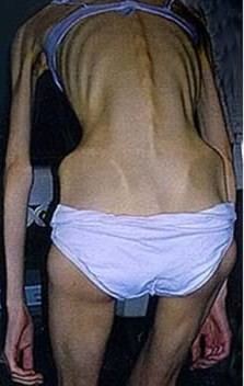 Anorexia 8 mother