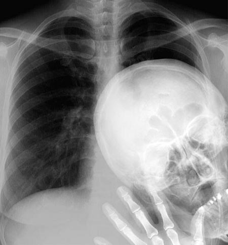 Peak a boo x ray