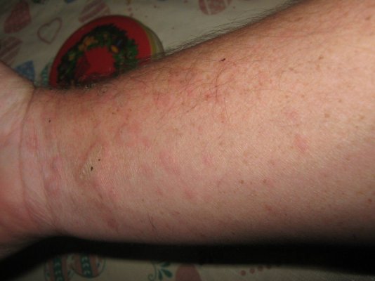 garys-arm.jpg