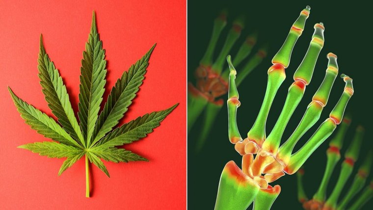 Does Cannabis Help Patients With Rheumatoid Arthritis?